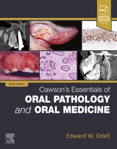 Cawson's Essentials of Oral Pathology and Oral Medicine - E-Book